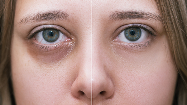 Before and after Restylane photo