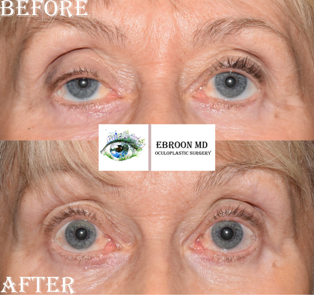 Ptosis Repair